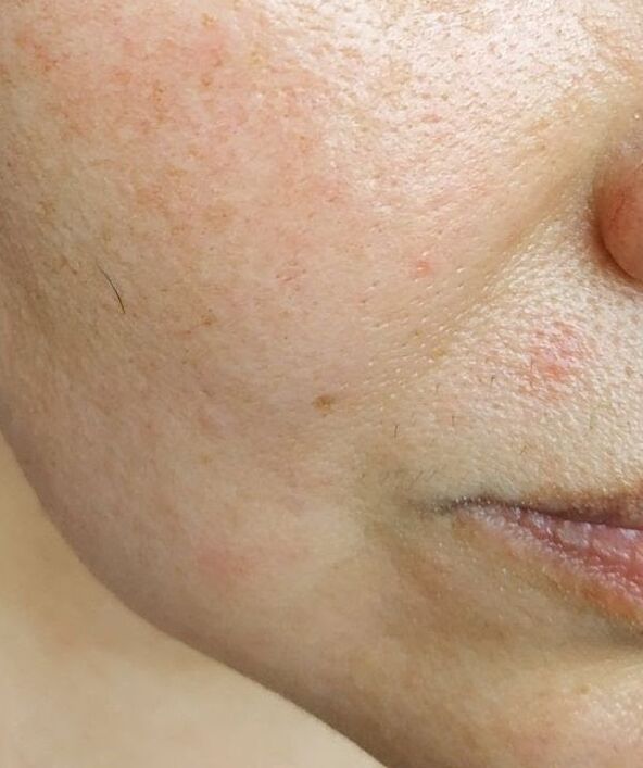 Intensinskin vabanes sügavatest nasolabiaalsetest voldidest